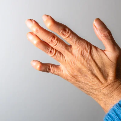 Polyarthralgia Treatment