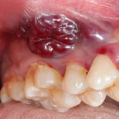 Treatment of Pre-Oral Cancer Lesions